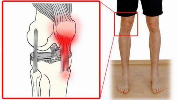 bol u zglobovima triceps bol u koljenu uzrokuje koga liječiti