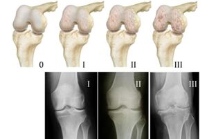 Složeno liječenje artroze koljena