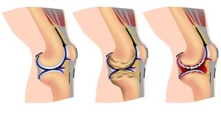 artroza liječenja ozonom koljena