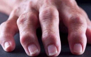 kako ublažiti upale zglobova i bolove kliknite na zglobove prstiju s boli
