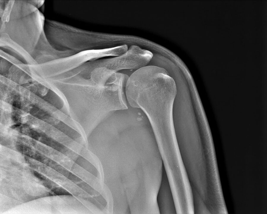 Rtg artroze ramenog zgloba 2. stupnja težine