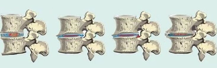 lezija kralježnice u slučaju torakalne osteohondroze