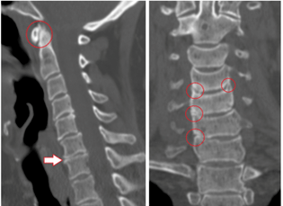 CT prikazuje oštećene kralješke i diskove heterogene visine zbog torakalne osteohondroze