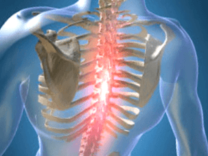 Ponavljajuća ili trajna bolna bol kod osteohondroze prsnog koša