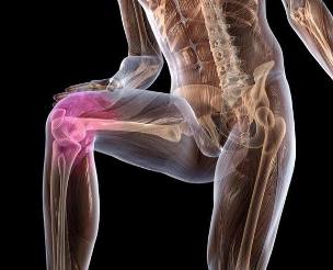 Upala zgloba koljena s artrozom