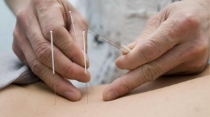 akupunktura za lumbalnu osteohondrozo