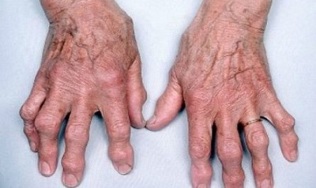 kako razlikovati artritis prstiju od artroze