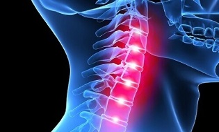 manifestacije osteohondroze vratne kralježnice