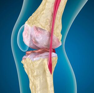 Artroza koljena